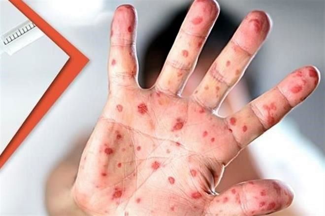 Suman 12 casos de sarampión en el País